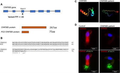 CFAP300 mutation causing primary ciliary dyskinesia in Finland